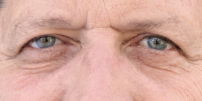 Comment lutter contre les paupières tombantes : solutions à découvrir